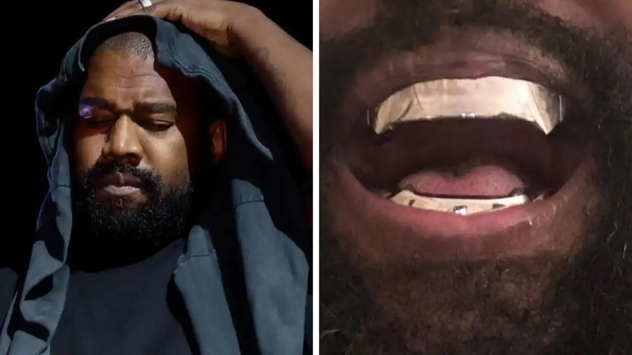 Kanye West retiró dientes y reemplazó dentaduras postizas de titanio de $ 1.3 millones